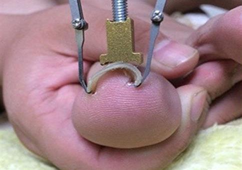 Eingewachsener Zehennagel