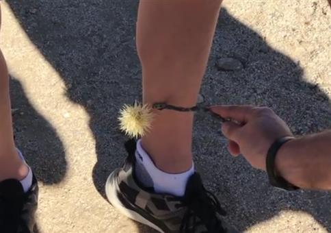 Kaktuskugel vom Bein entfernen