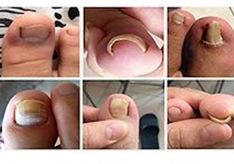 Eingewachsene Zehennägel